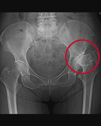 整骨院の施術内容：変形性股関節症