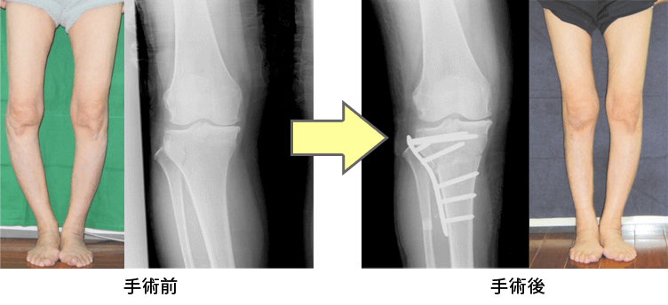 整骨院の施術内容：変形性膝関節症の治療