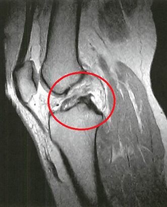 整骨院の施術内容：膝の靭帯損傷