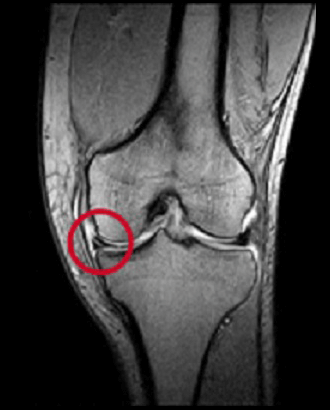 整骨院の施術内容：膝半月板損傷