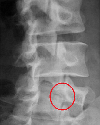整骨院の施術内容：腰部脊柱管狭窄症
